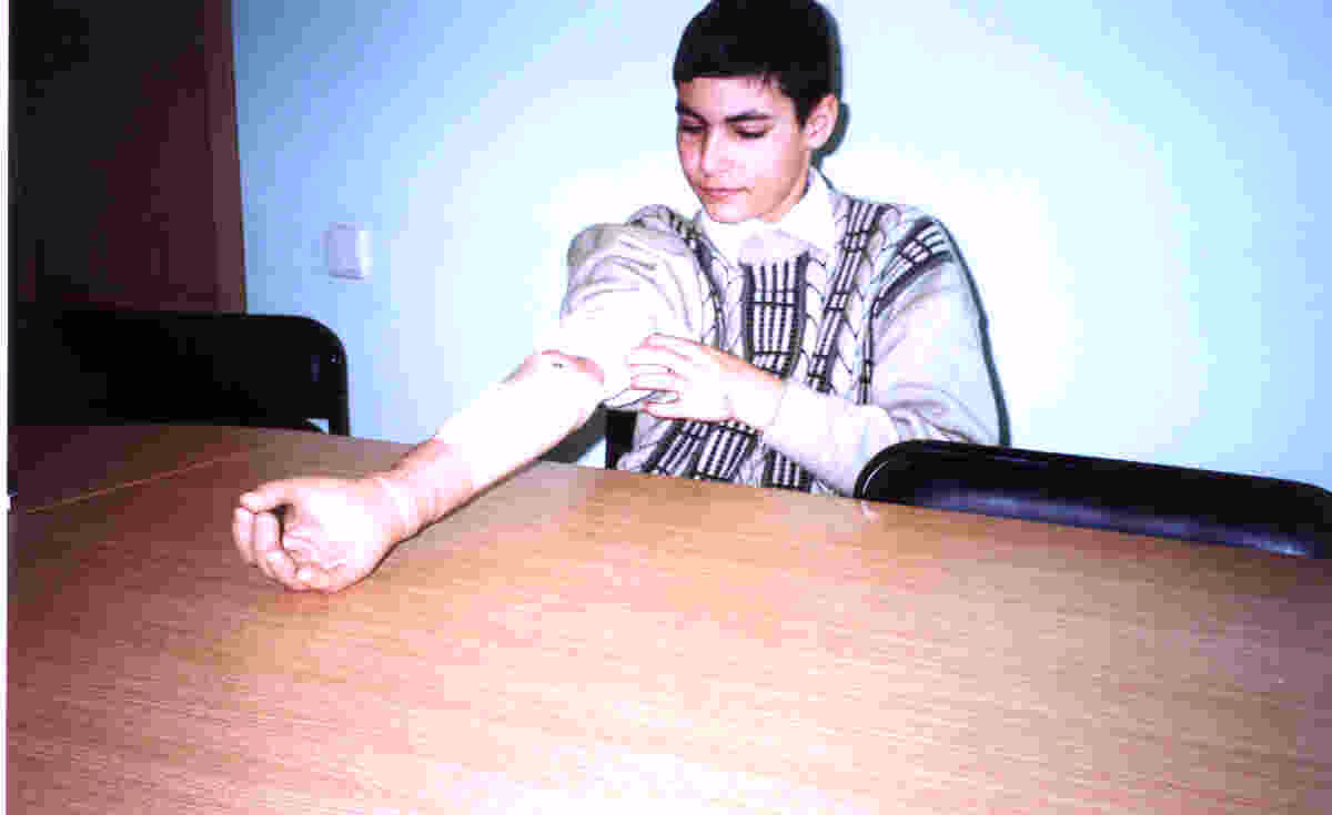  A prosthetic arm provided to a diabled child in Romania. 